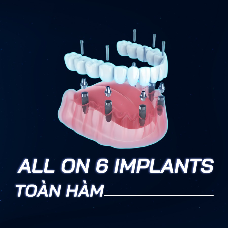Phương pháp All On 6 Implants toàn hàm là gì? Giá bao nhiêu?