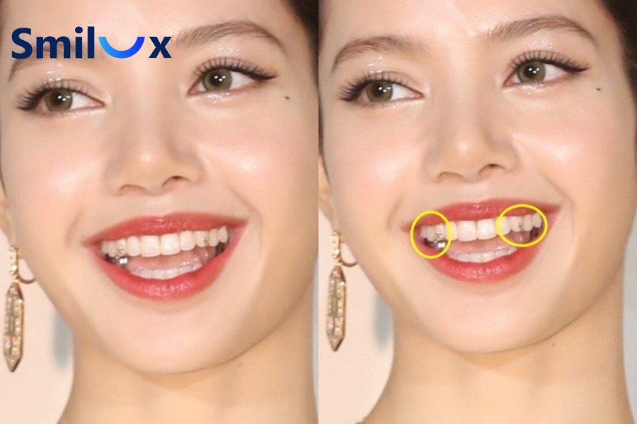 Các phương pháp gắn đá lên răng Các phương pháp gắn đá lên răng