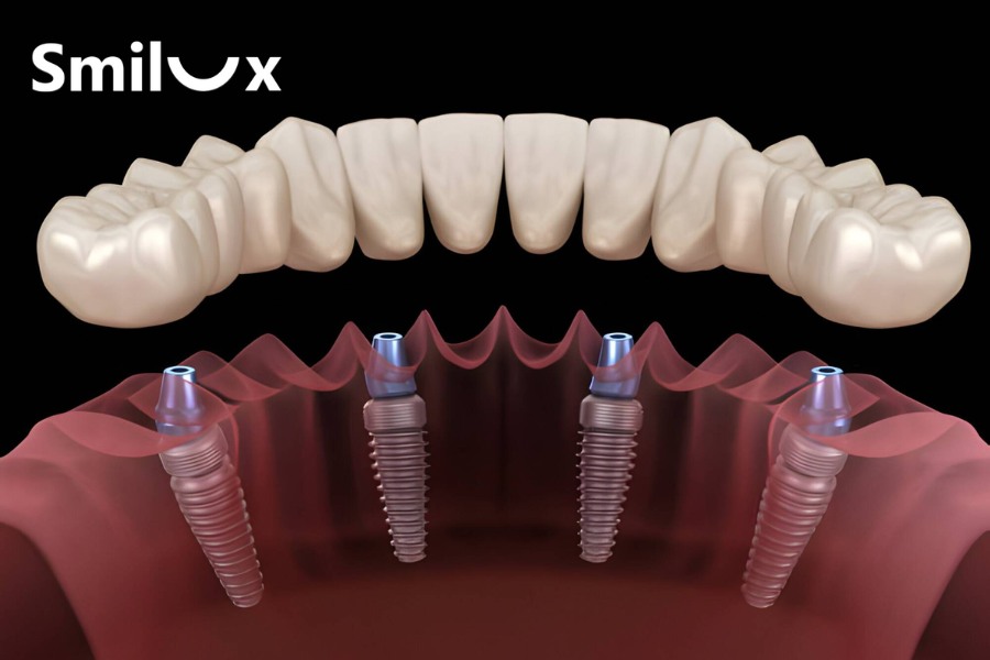 Răng phục hình có hình dáng và màu sắc hài hòa, mang lại cảm giác tự nhiên gần như răng thật Răng phục hình có hình dáng và màu sắc hài hòa, mang lại cảm giác tự nhiên gần như răng thật