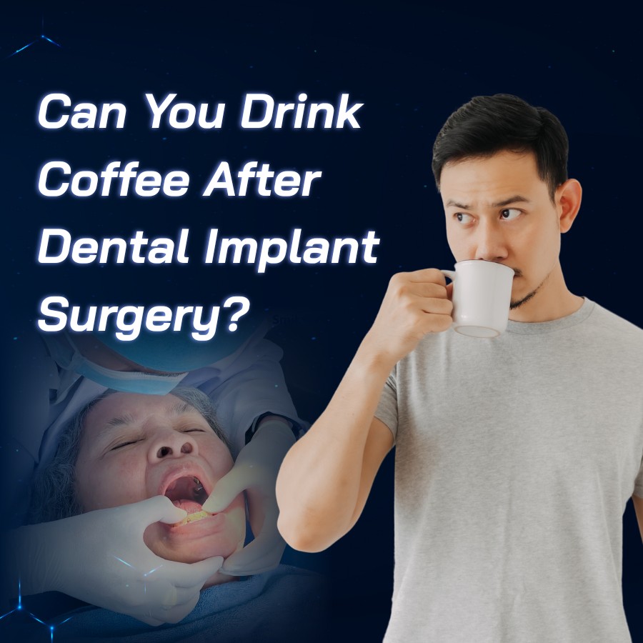 can you drink coffee after dental implant Surgery smilux dental