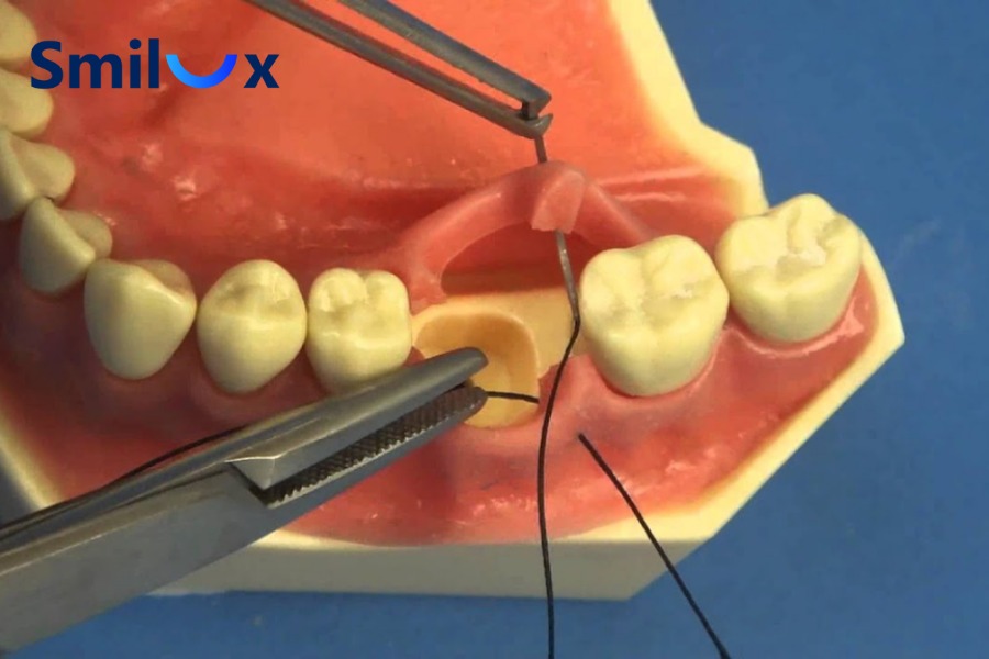 Thủ thuật cắt chỉ cắm Implant diễn ra nhanh, nhẹ nhàng Thủ thuật cắt chỉ cắm Implant diễn ra nhanh, nhẹ nhàng