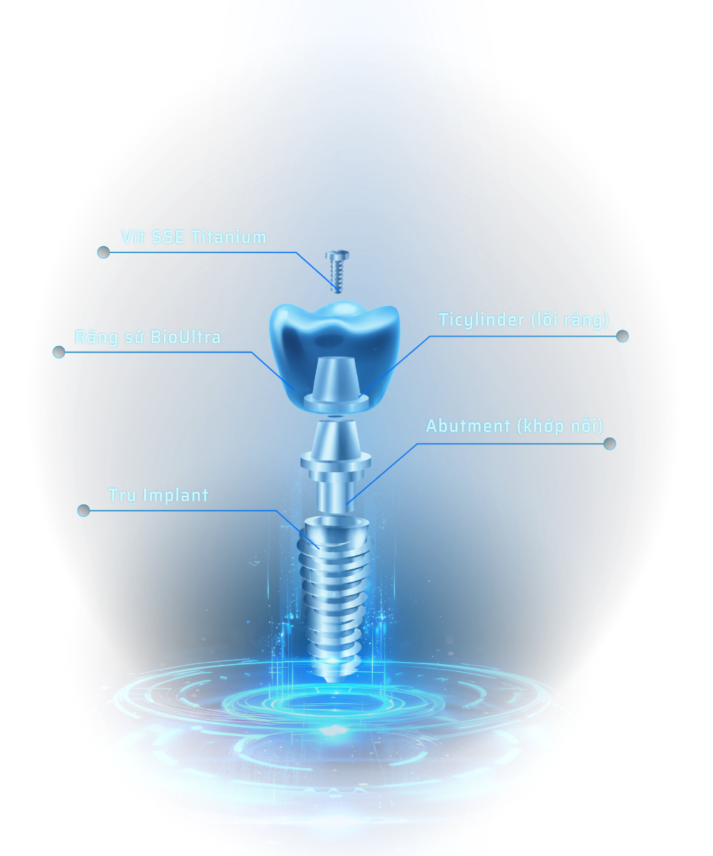 cau tao cua trong rang implant oti