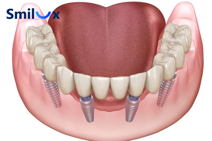 Cấy ghép Implant All-on-4 là phương pháp phục hình răng toàn hàm cố định bằng 4 trụ Implant Cấy ghép Implant All-on-4 là phương pháp phục hình răng toàn hàm cố định bằng 4 trụ Implant