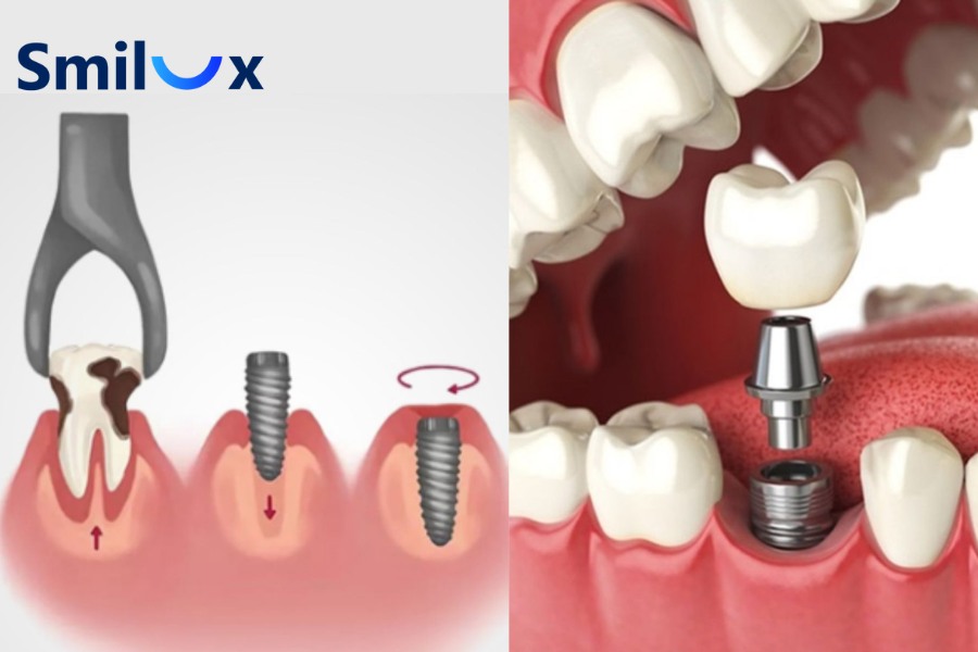 Cấy ghép Implant tức thì là kỹ thuật đặt trụ Implant ngay vào ổ xương vừa nhổ răng trong cùng một lần điều trị Cấy ghép Implant tức thì là kỹ thuật đặt trụ Implant ngay vào ổ xương vừa nhổ răng trong cùng một lần điều trị