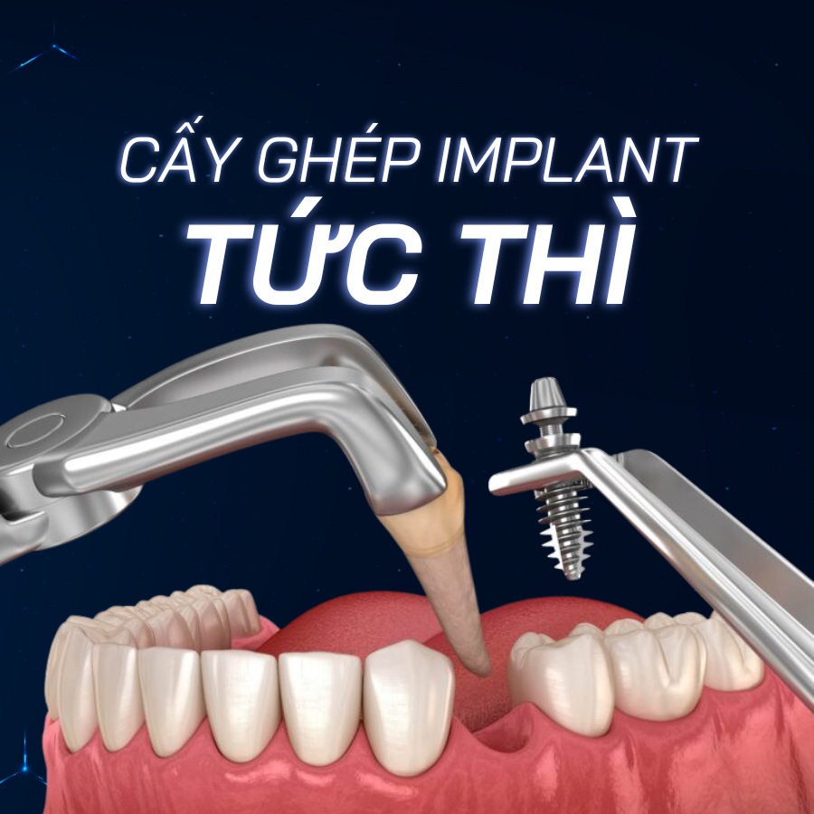 cấy ghép implant tức thì smilux