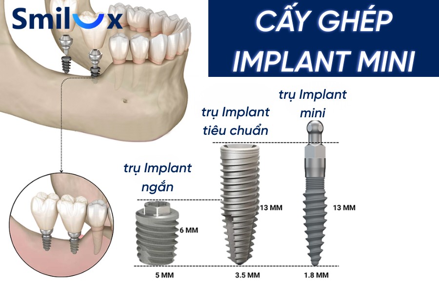 Cấy ghép Mini Implant là giải pháp phục hình răng bằng những trụ Implant có kích thước nhỏ hơn Cấy ghép Mini Implant là giải pháp phục hình răng bằng những trụ Implant có kích thước nhỏ hơn