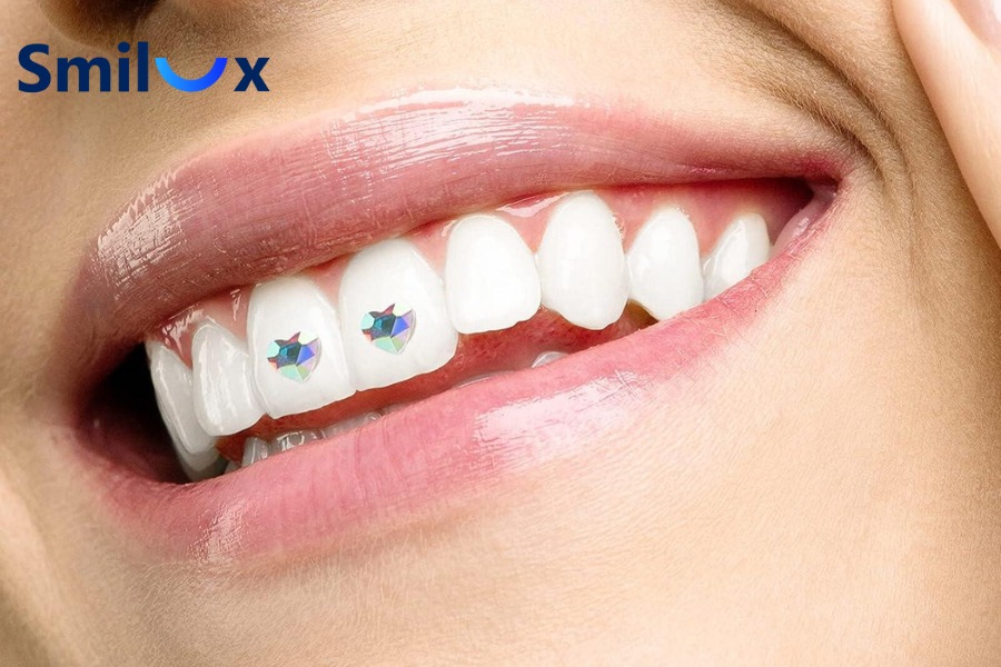 Có nên đính đá răng thẩm mỹ không? Có nên đính đá răng thẩm mỹ không?