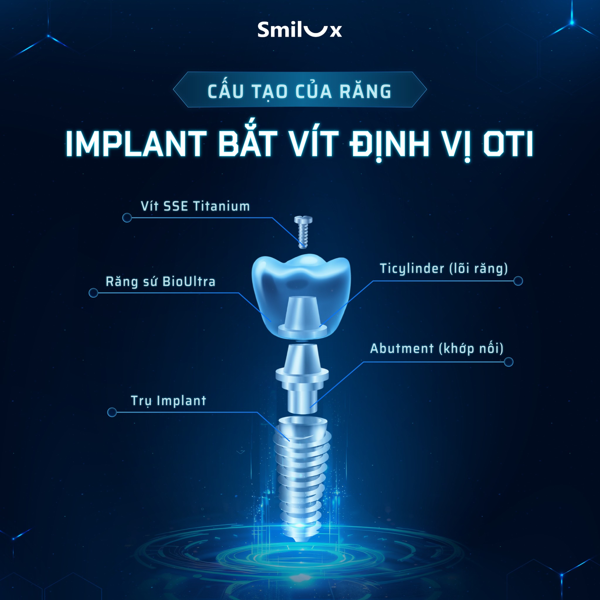công nghệ cấy ghép implant tại smilux