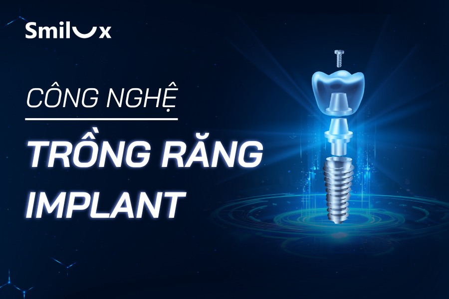Khám phá các công nghệ trồng răng Implant thế hệ mới tại Smilux