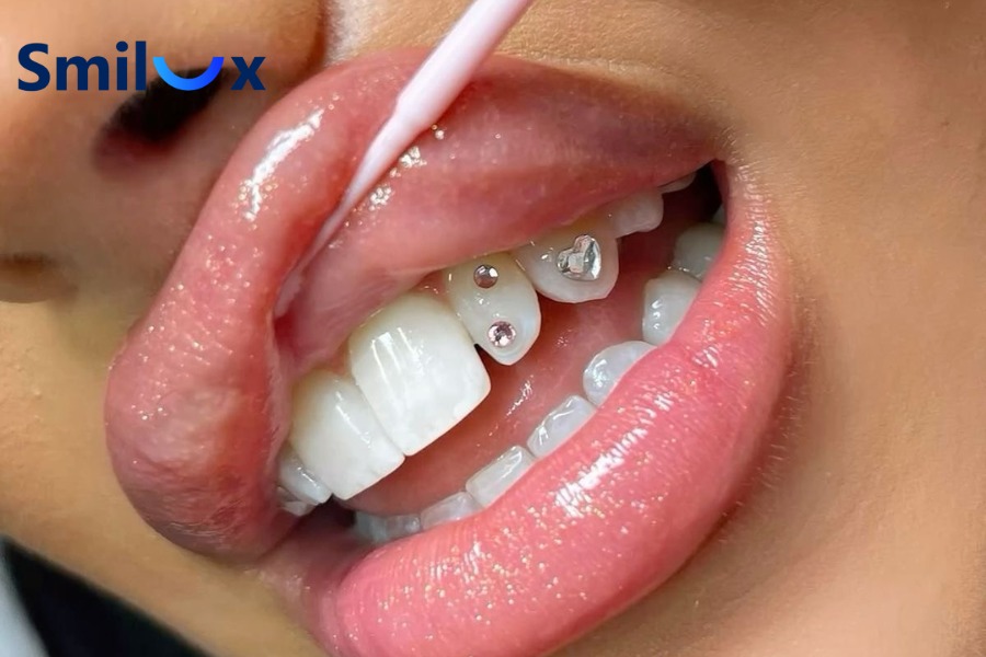 Gắn đá lên răng giúp tăng tính thẩm mỹ và tạo điểm nhấn cho nụ cười Gắn đá lên răng giúp tăng tính thẩm mỹ và tạo điểm nhấn cho nụ cười