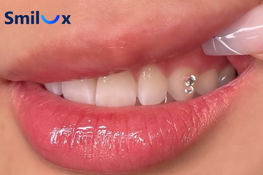 Đính đá lên răng là kỹ thuật thẩm mỹ nha khoa gắn đá nhỏ lên bề mặt răng bằng vật liệu chuyên dụng Đính đá lên răng là kỹ thuật thẩm mỹ nha khoa gắn đá nhỏ lên bề mặt răng bằng vật liệu chuyên dụng