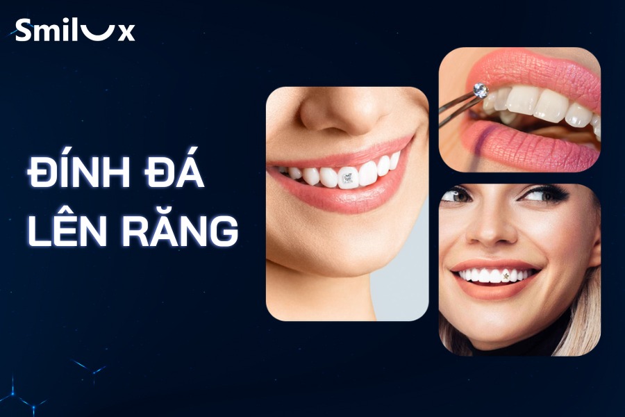 Đính đá lên răng thẩm mỹ có tốt không? Giá bao nhiêu tiền? Đính đá lên răng thẩm mỹ có tốt không? Giá bao nhiêu tiền?