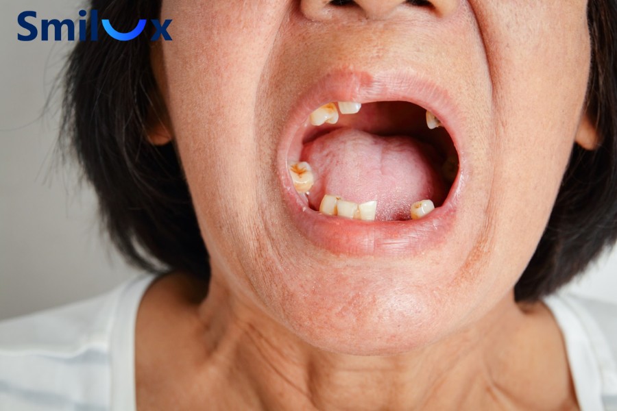 Mini Implants phù hợp với trường hợp xương hàm mỏng hoặc mật độ xương thấp Mini Implants phù hợp với trường hợp xương hàm mỏng hoặc mật độ xương thấp