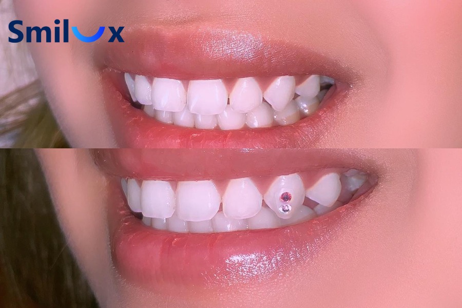 Hình ảnh đính đá lên răng đẹp Hình ảnh đính đá lên răng đẹp