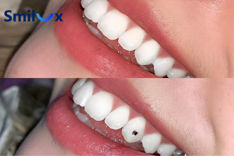 Hình ảnh răng đính đá đẹp Hình ảnh răng đính đá đẹp