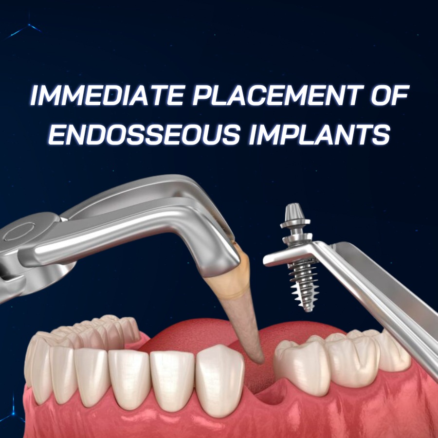 immediate placement of endosseous implants smilux