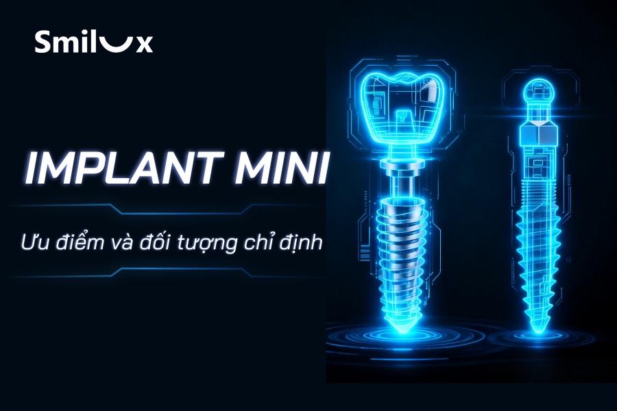 Trồng răng Implant mini là gì? Ưu điểm và đối tượng chỉ định Trồng răng Implant mini là gì? Ưu điểm và đối tượng chỉ định
