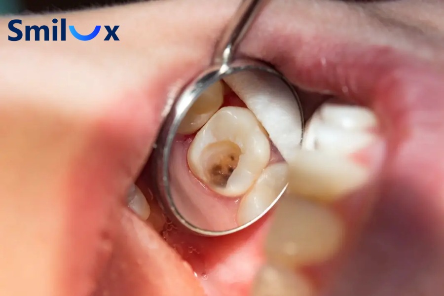 Bạn cần điều trị tủy răng khi mô tủy bên trong đã bị viêm hoặc hoại tử Bạn cần điều trị tủy răng khi mô tủy bên trong đã bị viêm hoặc hoại tử