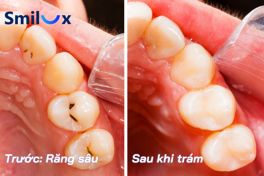 Khi nào cần thực hiện trám răng? Khi nào cần thực hiện trám răng?