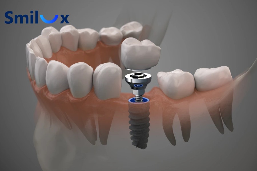 Cấy ghép Implant sai kỹ thuật là lý do khiến trồng răng Implant bị tiêu xương Cấy ghép Implant sai kỹ thuật là lý do khiến trồng răng Implant bị tiêu xương