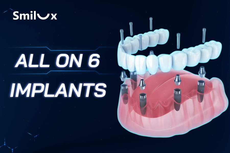 Phương pháp All On 6 Implants toàn hàm là gì? Giá bao nhiêu?