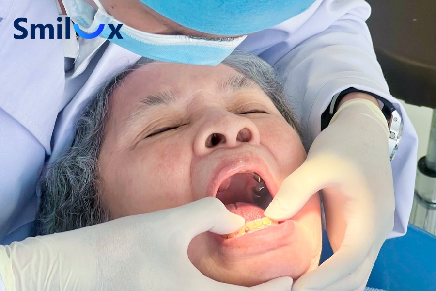 Quên cắt chỉ sau cắm Implant có thể gây ảnh hưởng đến quá trình lành thương Quên cắt chỉ sau cắm Implant có thể gây ảnh hưởng đến quá trình lành thương