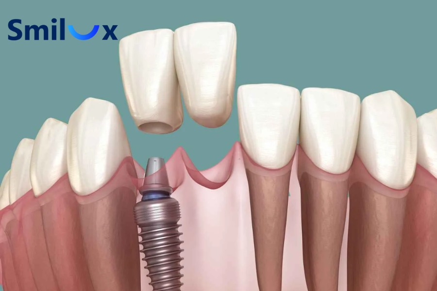 Viêm quanh trụ Implant do vi khuẩn tích tụ và vệ sinh kém có thể phá hủy dần mô nâng đỡ Viêm quanh trụ Implant do vi khuẩn tích tụ và vệ sinh kém có thể phá hủy dần mô nâng đỡ