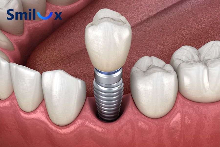 Hút thuốc lá có thể khiến vết thương trồng răng Implant lâu lành
