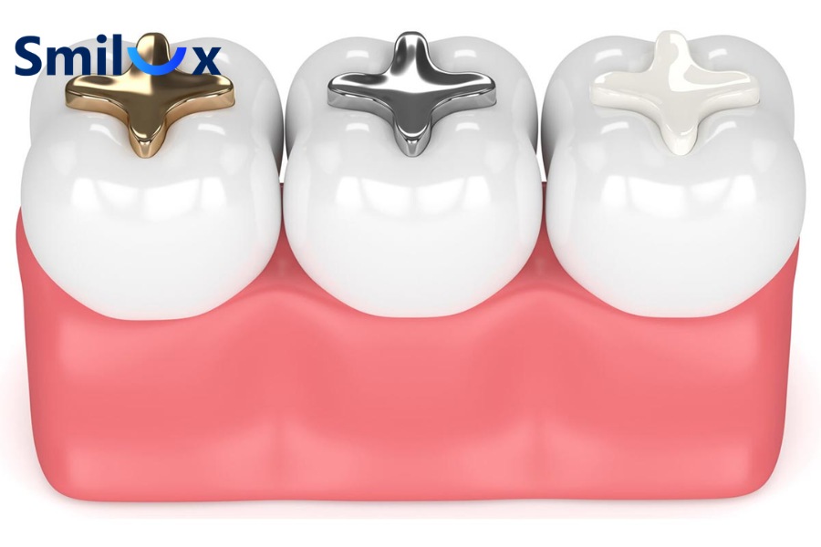 Trám răng bằng vàng/kim loại quý Trám răng bằng vàng/kim loại quý