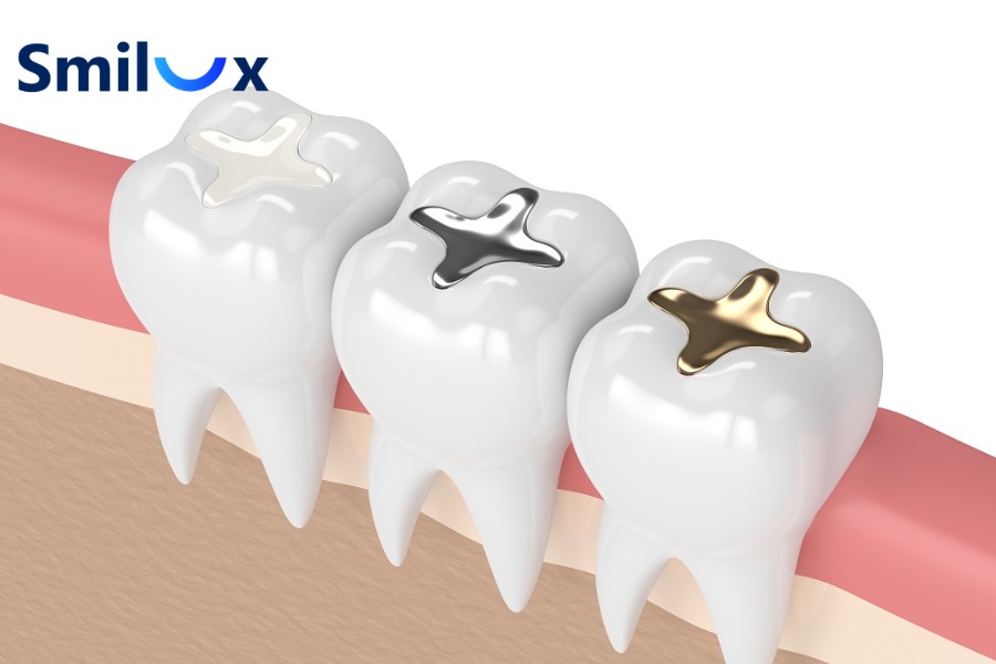 Trám răng sử dụng các vật liệu nha khoa để lấp đầy khoảng trống của răng bị sâu, nứt mẻ Trám răng sử dụng các vật liệu nha khoa để lấp đầy khoảng trống của răng bị sâu, nứt mẻ