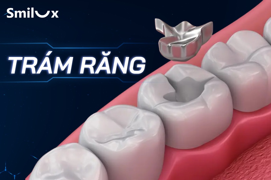 Trám răng là gì? Khi nào cần thực hiện? Chi phí và quy trình Trám răng là gì? Khi nào cần thực hiện? Chi phí và quy trình