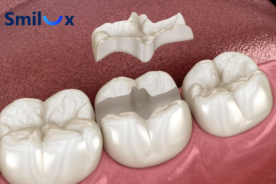 Trám Inlay/Onlay sứ Trám Inlay/Onlay sứ