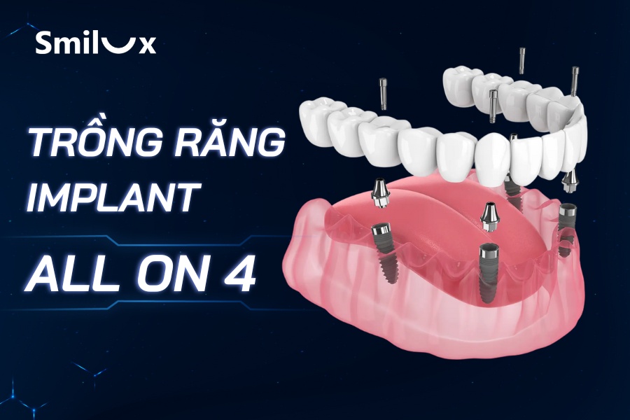 Trồng răng Implant All On 4 toàn hàm là gì? Giá bao nhiêu? Trồng răng Implant All On 4 toàn hàm là gì? Giá bao nhiêu?
