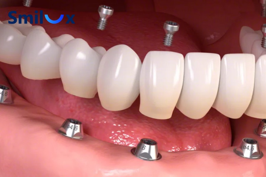 Trồng răng Implant All-on-6 là phương pháp phục hình răng toàn hàm bằng cách cấy 6 trụ Implant vào xương hàm