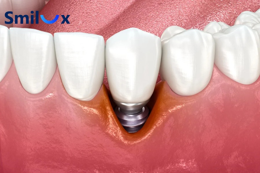 Biến chứng khi tình trạng răng Implant bị tiêu xương kéo dài Biến chứng khi tình trạng răng Implant bị tiêu xương kéo dài