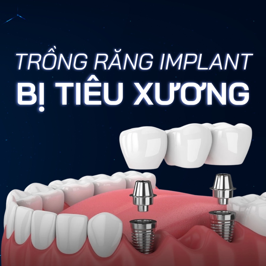 trồng răng implant bị tiêu xương smilux dental