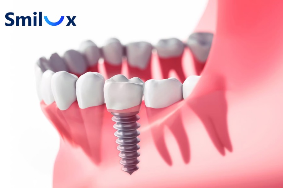 Thông thường, trồng răng Implant không gây tiêu xương hàm Thông thường, trồng răng Implant không gây tiêu xương hàm