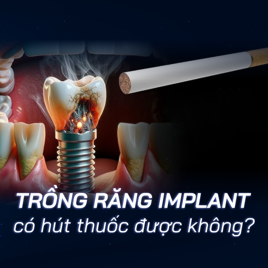 Trồng răng Implant có hút thuốc được không