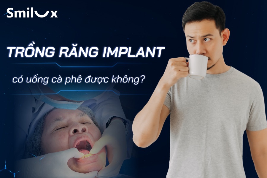 Trồng Implant có được uống cà phê không? Bác sĩ Smilux Trồng Implant có được uống cà phê không? Bác sĩ Smilux