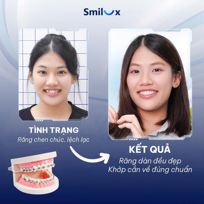 trước sau niềng răng biolight 1