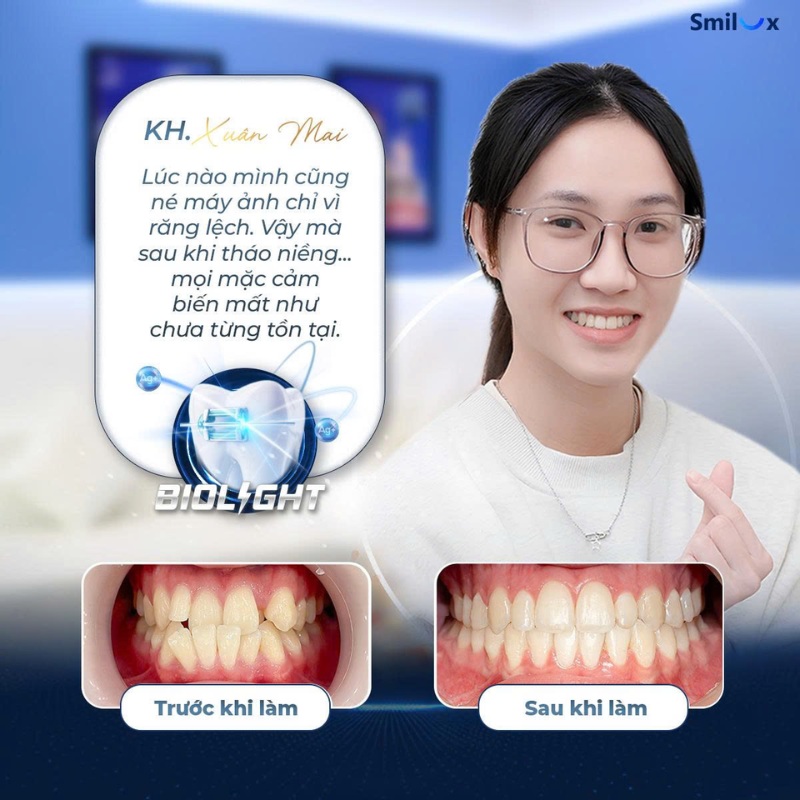 trước sau niềng răng biolight 2