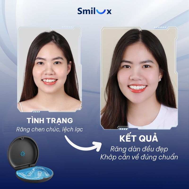 trước sau niềng răng biolight 3