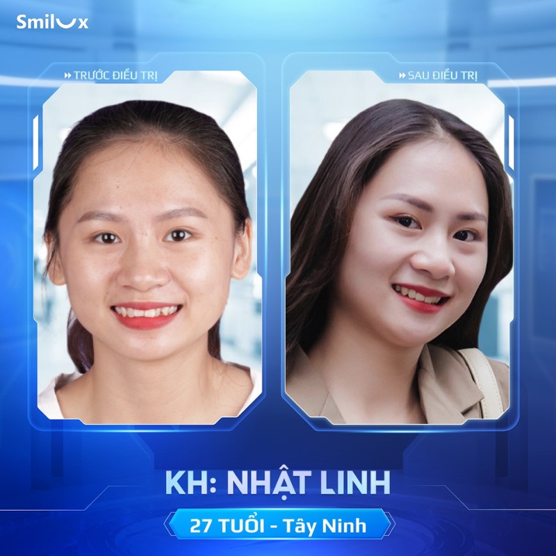 trước sau niềng răng biolight 4