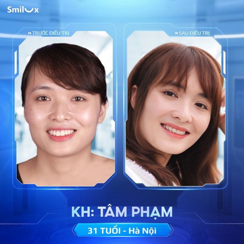 trước sau niềng răng biolight 5