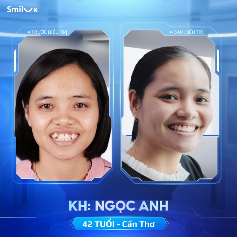 trước sau niềng răng biolight 6