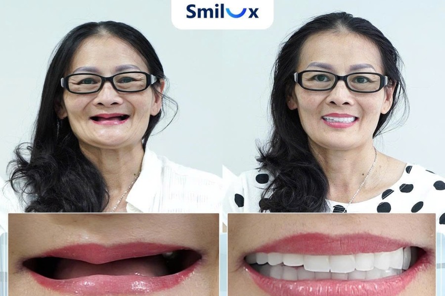 Cô chú mất răng toàn hàm hoặc gần toàn hàm có thể cân nhắc trồng răng Implant All On 4