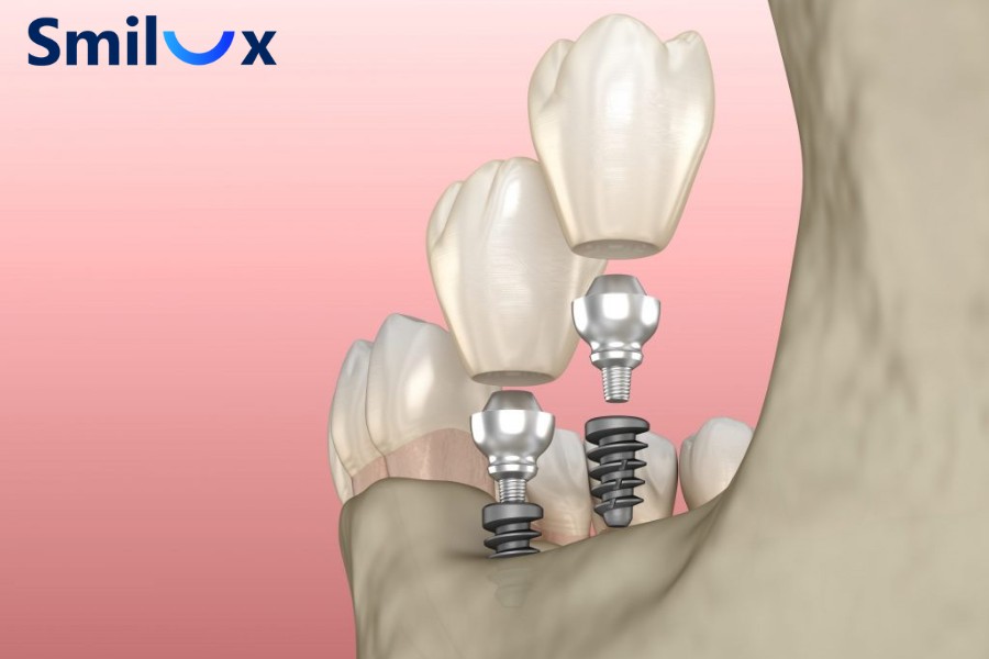 Ưu điểm của Implant mini là ít xâm lấn, giảm đau và sưng sau cấy ghép Ưu điểm của Implant mini là ít xâm lấn, giảm đau và sưng sau cấy ghép