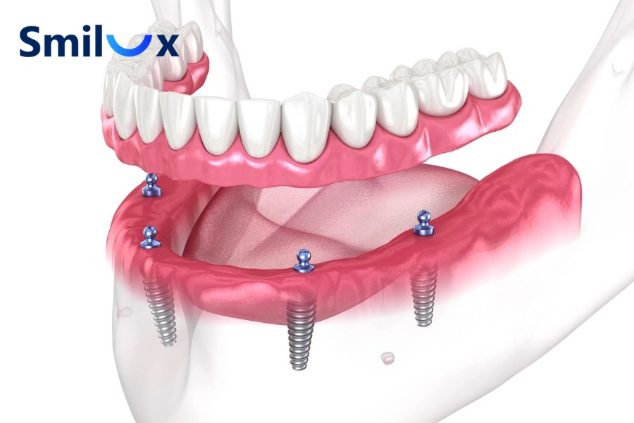 Cấy ghép Implant All On 4 hạn chế xâm lấn, giúp giảm đau, rút ngắn thời gian điều trị Cấy ghép Implant All On 4 hạn chế xâm lấn, giúp giảm đau, rút ngắn thời gian điều trị