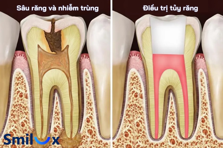 Chữa tủy răng sớm giúp giữ lại răng thật, còn nếu để lâu, nhiễm trùng lan rộng có thể khiến răng phải nhổ bỏ Chữa tủy răng sớm giúp giữ lại răng thật, còn nếu để lâu, nhiễm trùng lan rộng có thể khiến răng phải nhổ bỏ