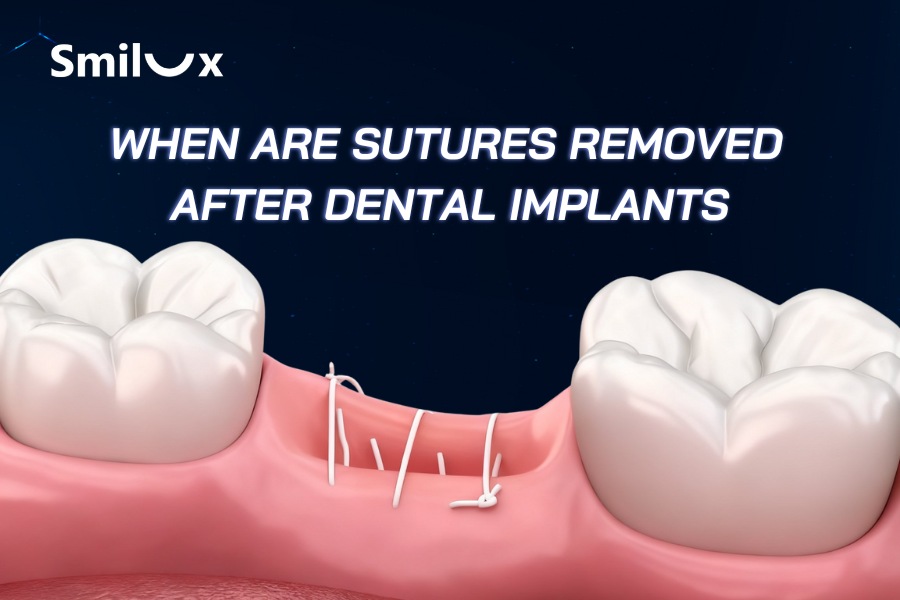 When Are Sutures Removed After Dental Implants? When Are Sutures Removed After Dental Implants?